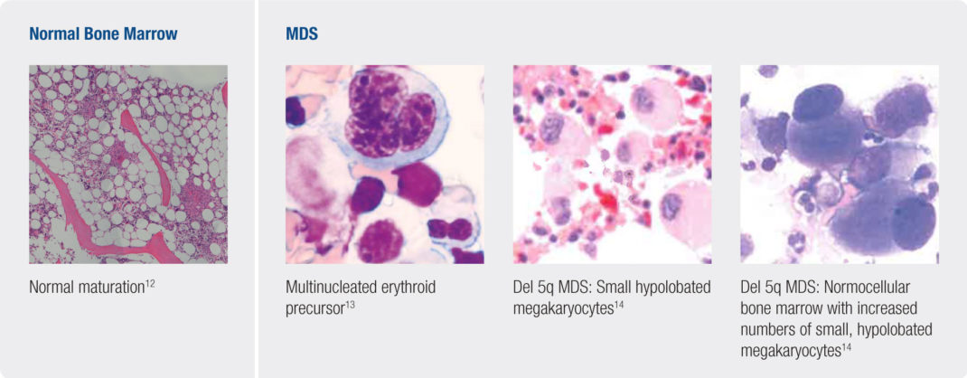Bone Marrow in Del 5q Myelodysplastic Syndromes (MDS)